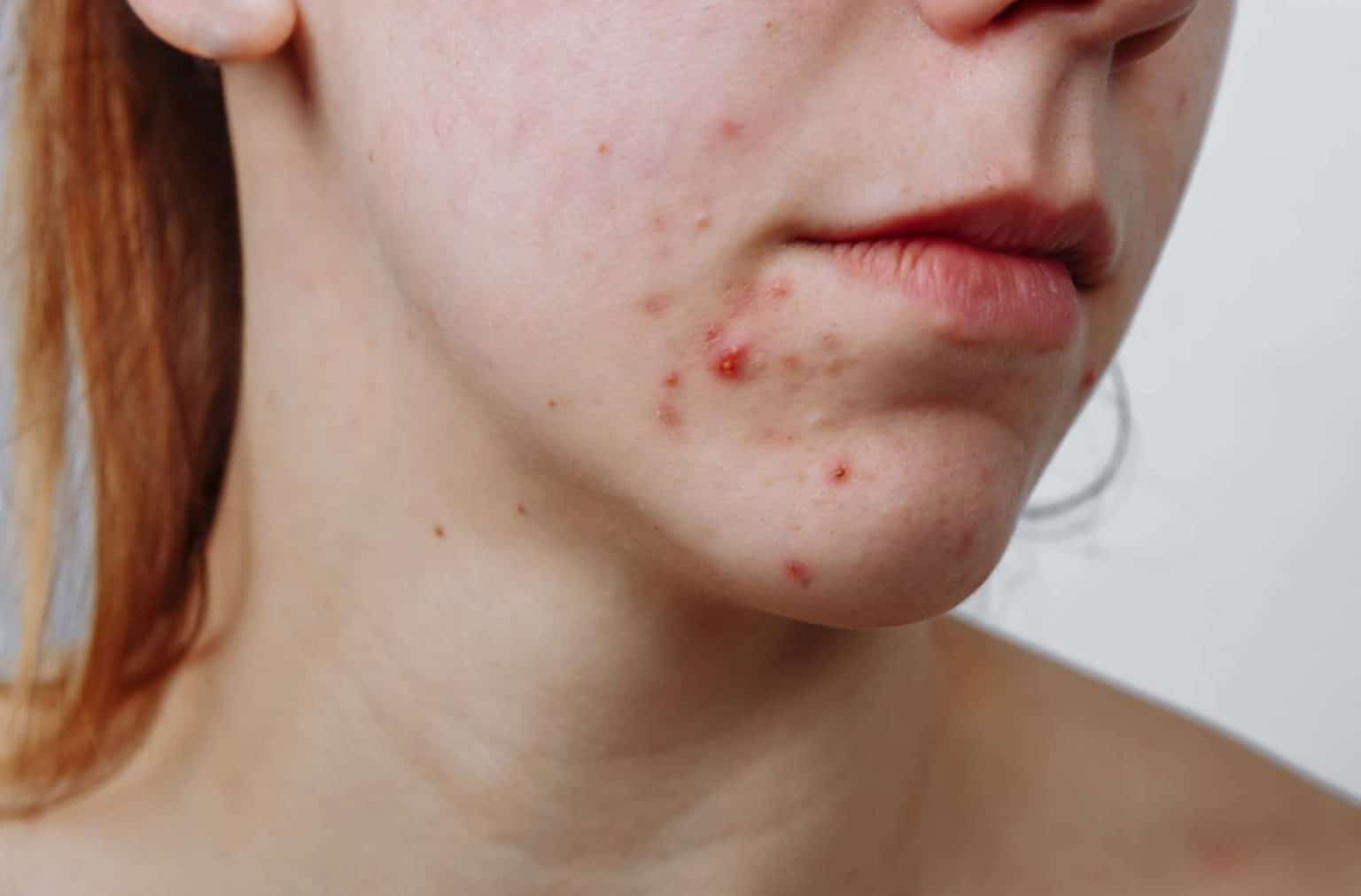 L’acné du visage : remède des dermatologues
