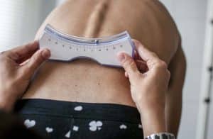 Les premiers signes de scoliose chez un enfant